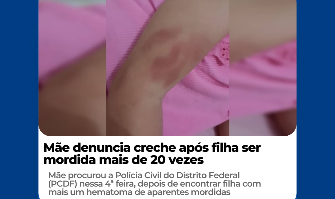 Mãe denuncia creche após filha ser mordida mais de 20 vezes